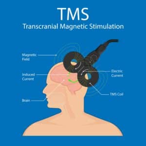 The Pros and Cons of TMS Therapy